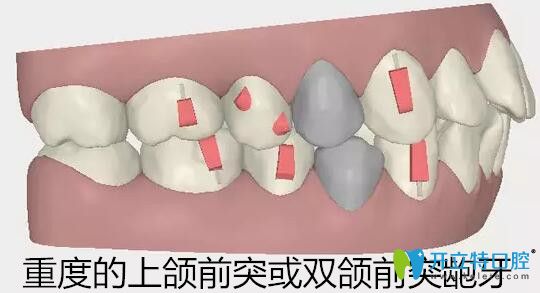 隱適美適合矯正重度的上頜前突或雙頜前突齙牙
