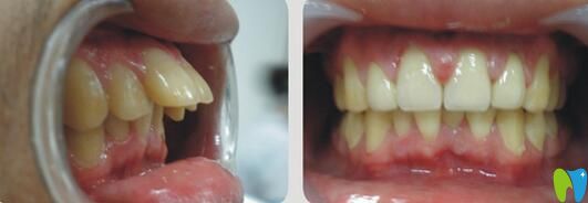 隱適美矯正齙牙案例圖片