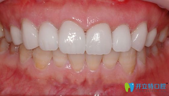 超薄全瓷牙貼面修復(fù)后效果圖