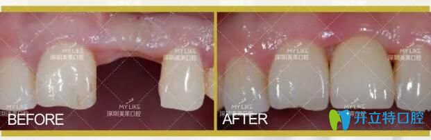 深圳美萊口腔單顆種植牙案例