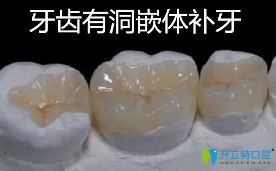 牙齒有洞嵌體補牙