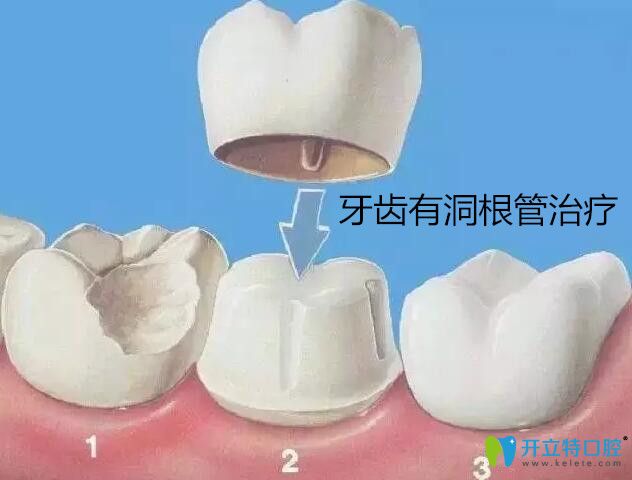 牙齒有洞根管治療