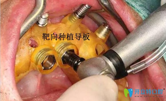 南京博韻口腔種植導板術(shù)中使用圖