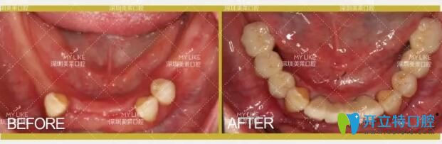 深圳美萊口腔多顆種植牙案例
