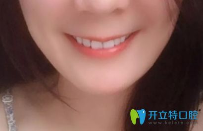 我在深圳諾德齒科做牙齒矯正后的效果圖