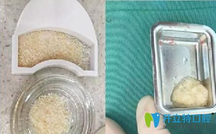 種植牙的人工骨粉 種植牙的人工骨粉