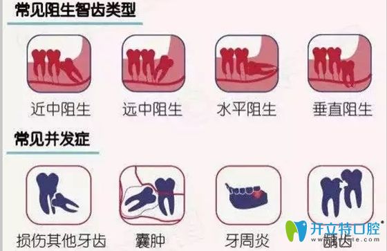 常見阻生智齒的類型
