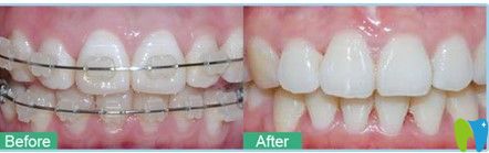 在深圳鵬程口腔林小姐做的陶瓷矯正前后對比圖