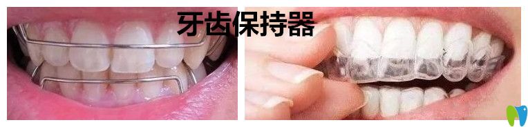 成人牙齒矯正后戴好保持器就不會反彈