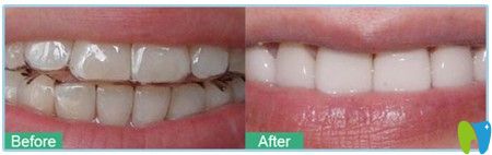 廖小姐門牙微突出在深圳鵬程醫(yī)院做的隱形矯正