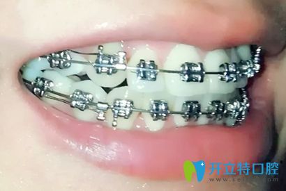 我戴的金屬托槽牙套