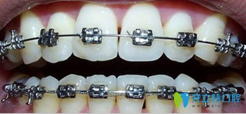 托槽牙套換鋼絲是為了更好的加力