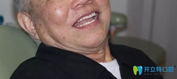 林老伯做完半口種植牙后談感受