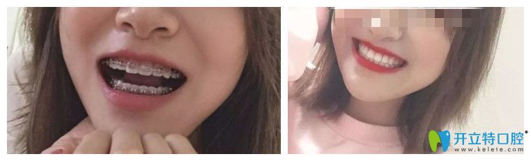 矯正后牙齒圖片 矯正后牙齒圖片