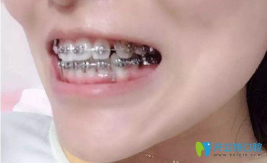 牙齒矯正9個(gè)多月圖片 牙齒矯正9個(gè)多月圖片