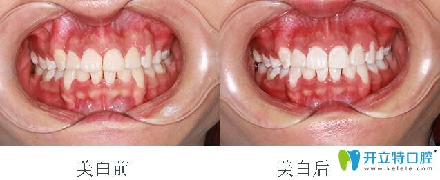 在深圳格倫菲爾口腔矯正后做牙齒美白