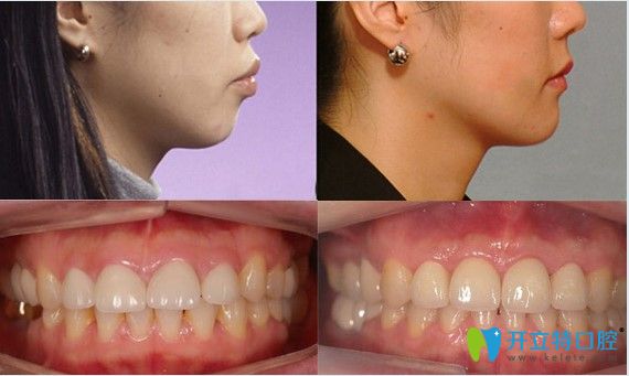 齙牙矯正， 隱形矯正16個月效果圖