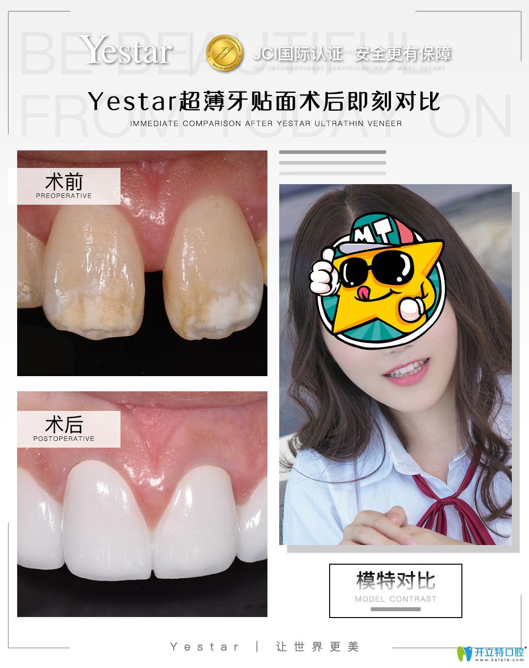 藝星口腔超薄牙貼面案例對比照片