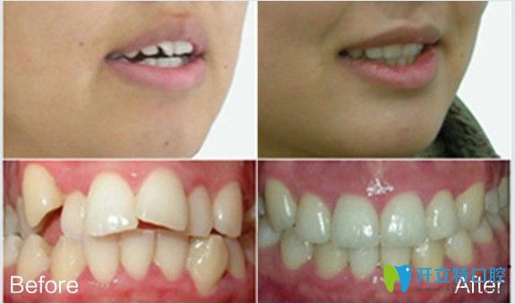華美口腔醫(yī)院王先生隱形矯正15個月效果圖