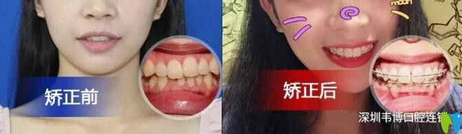 門牙前突小姐姐矯正后完成顏值逆襲