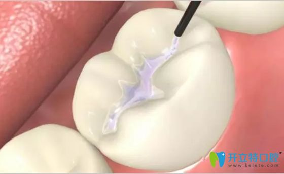 窩溝封閉劑的主要成分是什么