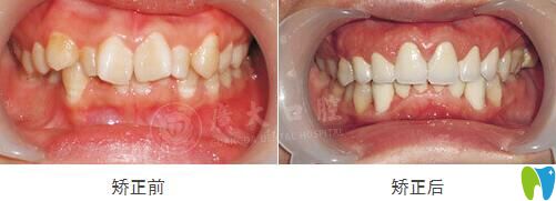 牙齒擁擠不齊在廣大口腔做GA精準(zhǔn)矯正效果