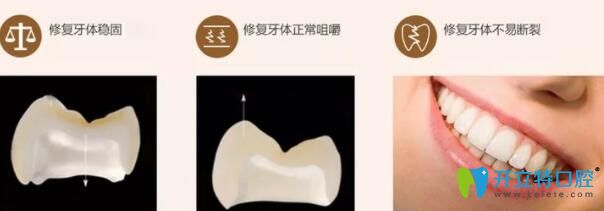 威蘭德全瓷牙的優(yōu)缺點