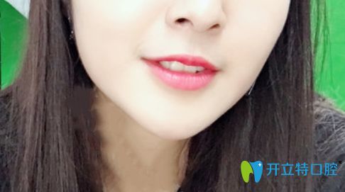 我在珠海九龍口腔做的隱形矯正價格是2萬元起