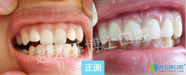 超龍牙博士口腔牙齒擁擠前凸矯正案例圖 超龍牙博士口腔牙齒擁擠前凸矯正案例圖
