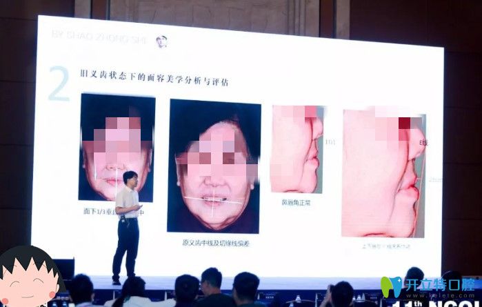 北京維樂口腔時(shí)紹忠美學(xué)修復(fù)講解圖