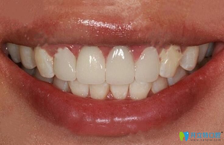 珠海九龍口腔陳軍即刻種植牙效果圖