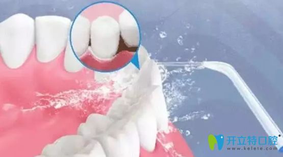 超聲波潔牙示意圖