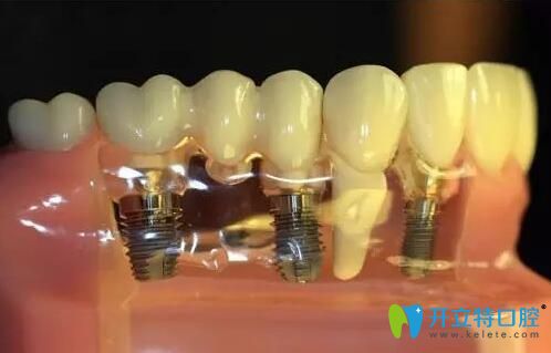 瑞士ITI種植體親水和非親水的區(qū)別