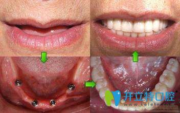 趙阿姨在昆明尚愛(ài)韓美口腔做完種植牙的圖片