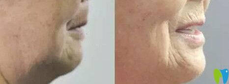 趙阿姨在尚愛(ài)韓美做全口種植牙前后對(duì)比圖