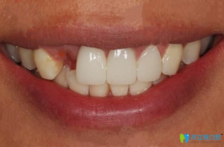 去珠海九龍口腔做即刻種植牙前