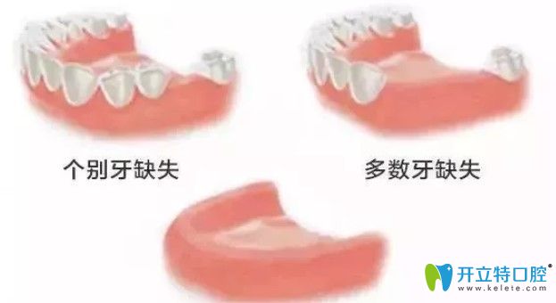 牙齒缺失情況圖示