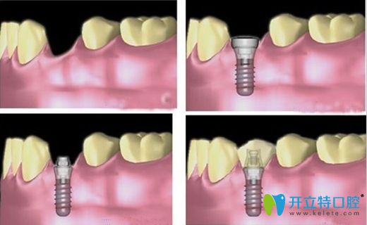 種植牙的并發(fā)癥發(fā)生是受到很多因素影響的