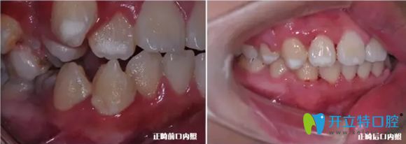 牙齒側(cè)面正畸前后對(duì)比效果圖 牙齒側(cè)面正畸前后對(duì)比效果圖