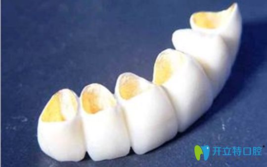 鈀金烤瓷牙是屬于半貴金屬烤瓷牙的一種