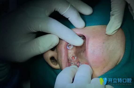 武漢清華陽光口腔種植牙手術(shù)過程