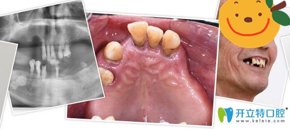 沒(méi)有來(lái)廣州廣大口腔做種植牙前