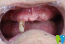 在深圳格倫菲爾口腔做全口種植牙前