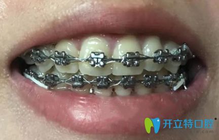 在深圳好佰年矯正牙齒9個(gè)月的效果圖 在深圳好佰年矯正牙齒9個(gè)月的效果圖