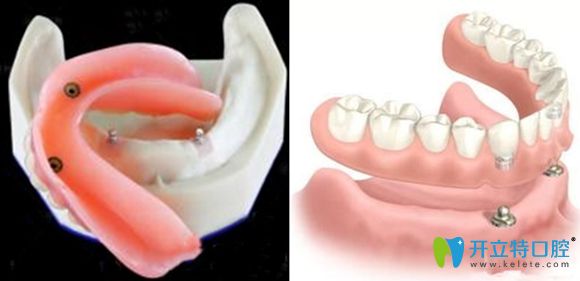 拜博口腔球帽半固定修復(fù) 拜博口腔球帽半固定修復(fù)