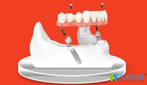 新鄉(xiāng)拜博口腔2顆種植體就可修復(fù)半口牙 新鄉(xiāng)拜博口腔2顆種植體就可修復(fù)半口牙