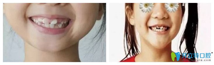 于淋醫(yī)生解答：換牙的時(shí)候舔牙牙齒會(huì)長歪，這是真的嗎？