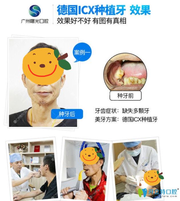 曙光口腔德國ICX種植牙效果展示