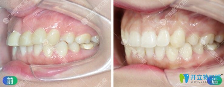 曙光口腔齙牙矯正前后對(duì)比照片 曙光口腔齙牙矯正前后對(duì)比照片