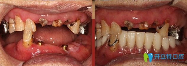廣大口腔給韓重聲老人做種植牙的前后對比圖